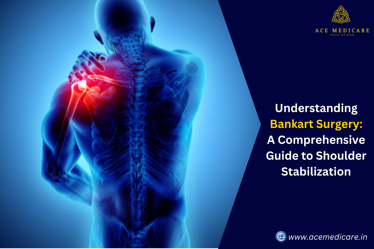 Understanding Bankart Surgery: A Comprehensive Guide to Shoulder Stabilization